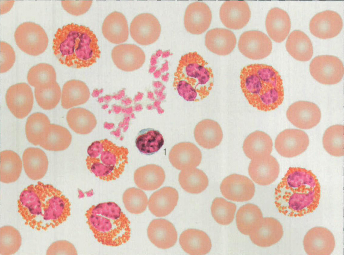 图102 嗜酸性粒细胞增多症血象